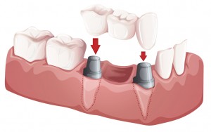 Marrero dental restorations