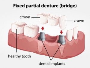 Marrero dental implants
