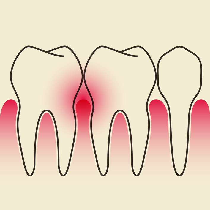 Marrero periodontal treatment
