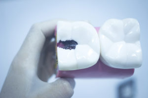 broken filling icd 10