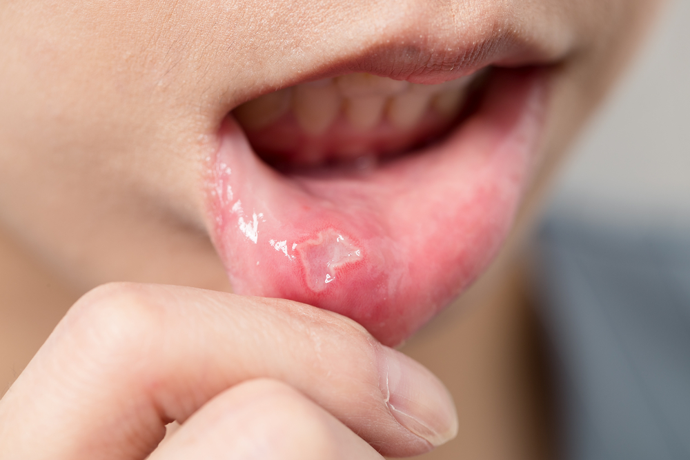 What causes canker sores