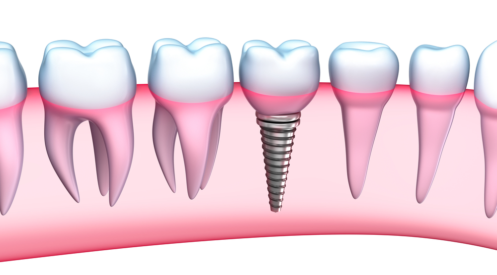 graphic of dental implant in jaw