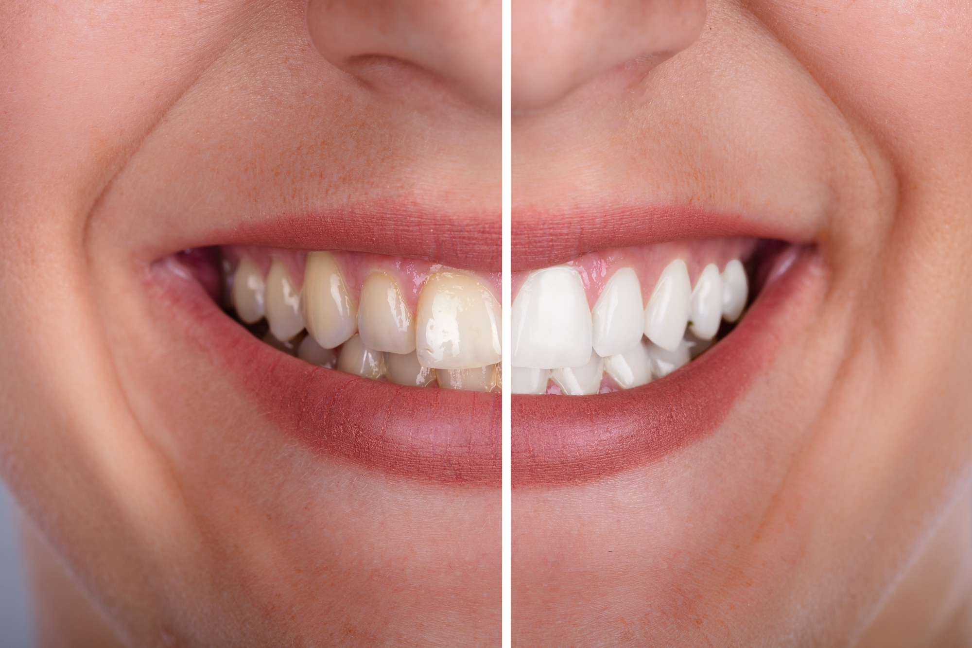 Teeth before and after teeth whitening. 