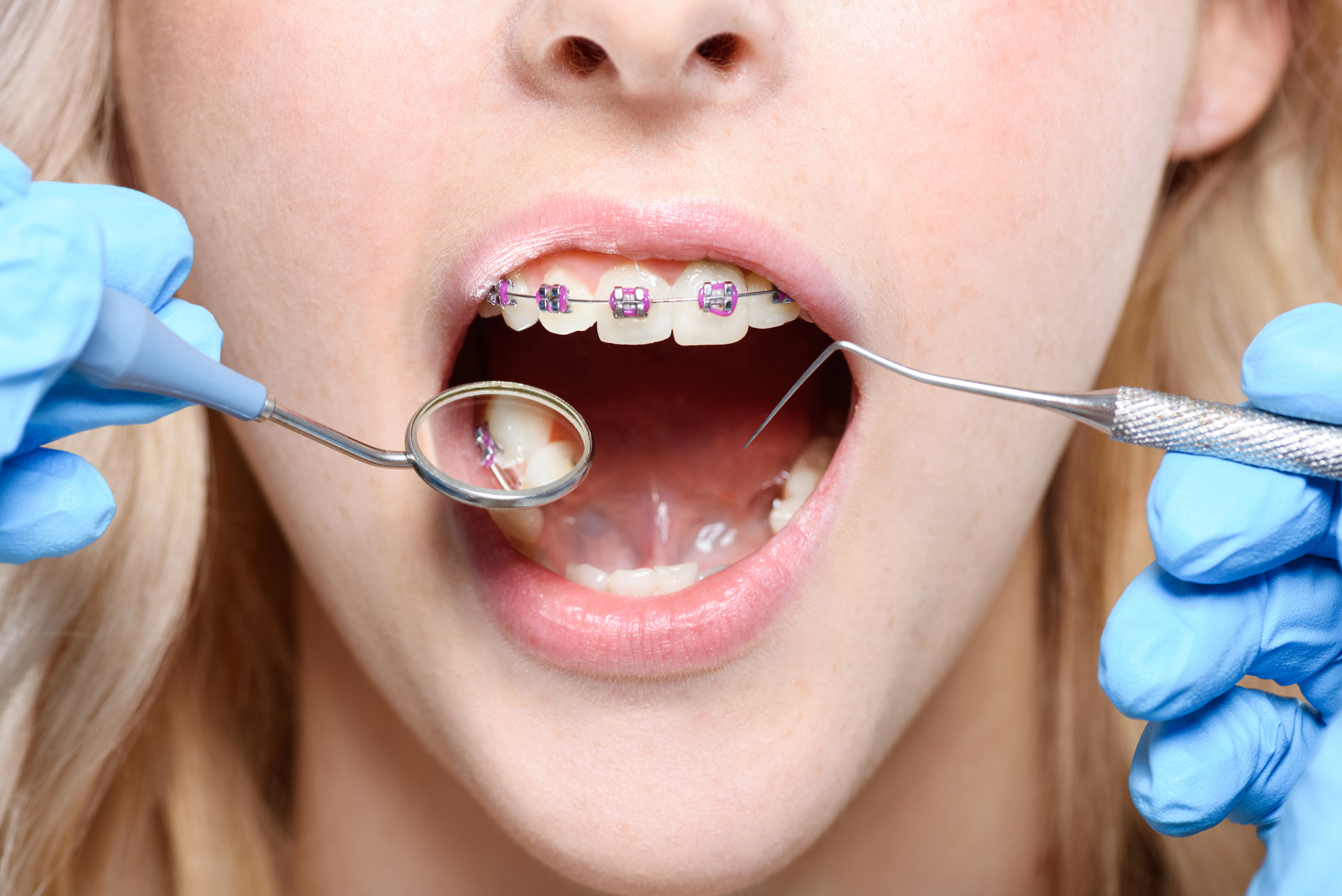 Close up of person with braces getting dental exam