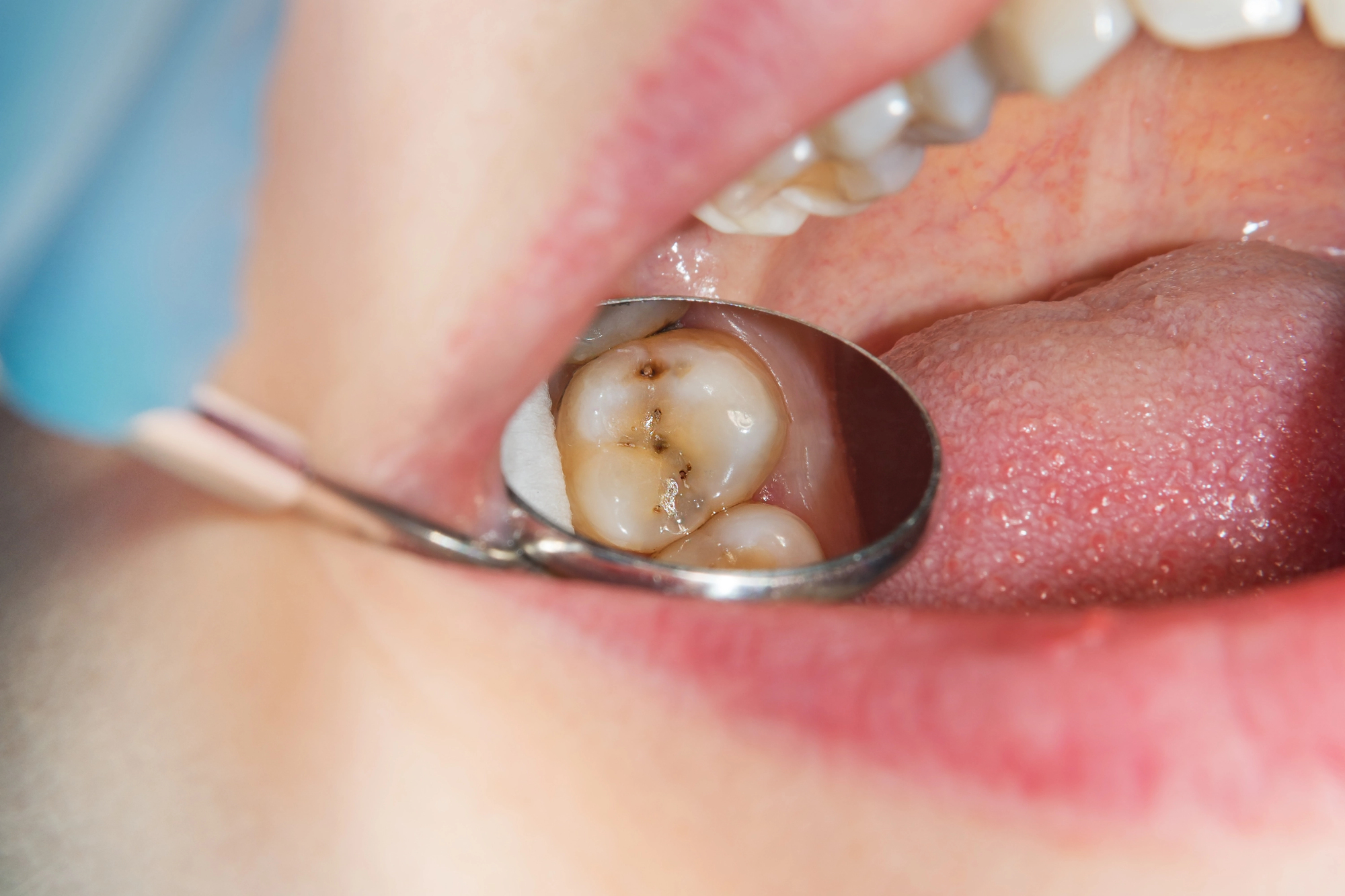 Close up of oral exam showing a cavity