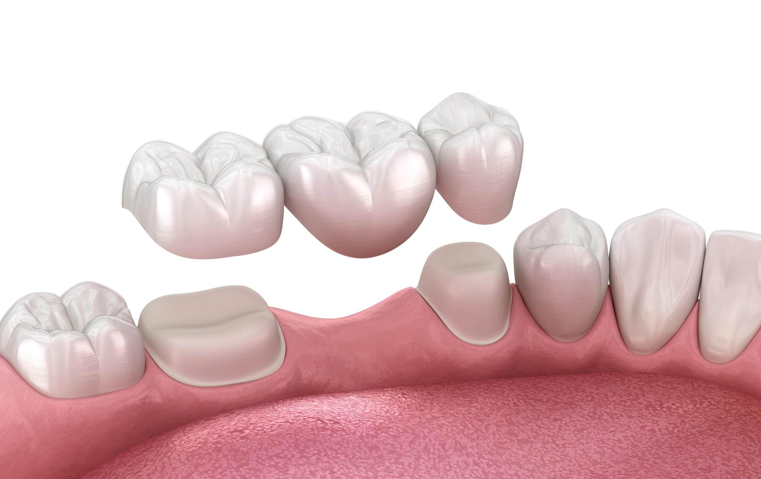 Image of a dental bridge