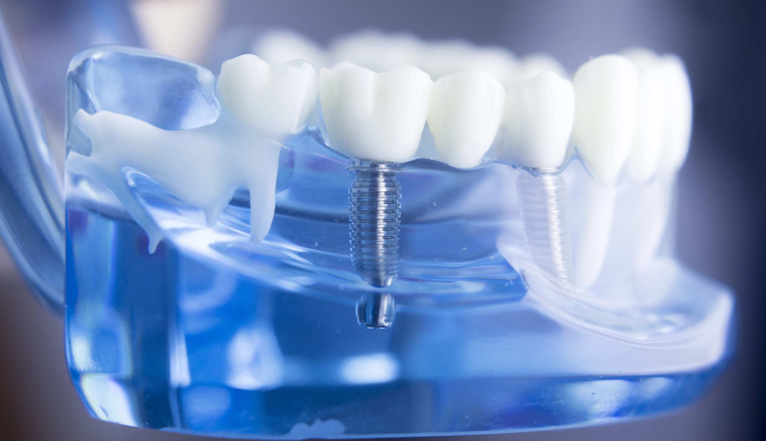 Close up of model of dental implant. 
