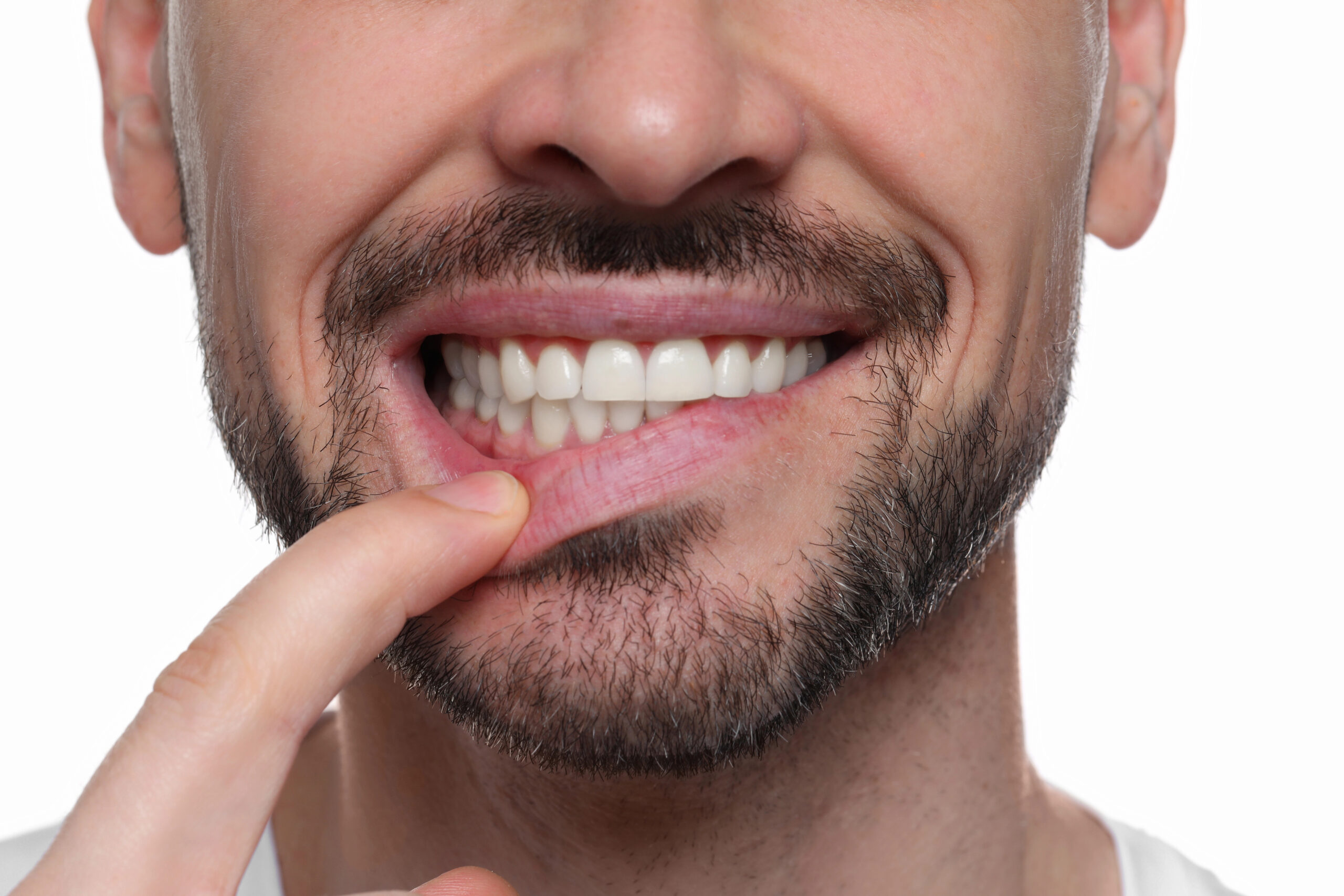 Close up of man with swollen gums. 