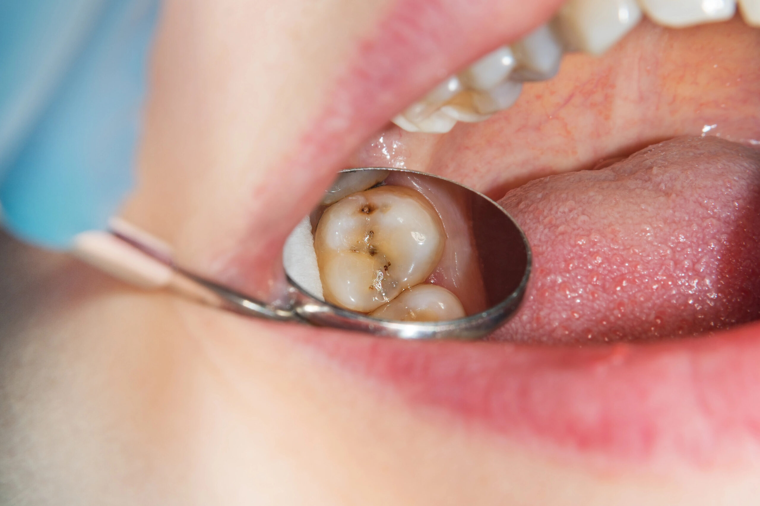 Close up of tooth decay resulting in cavities.