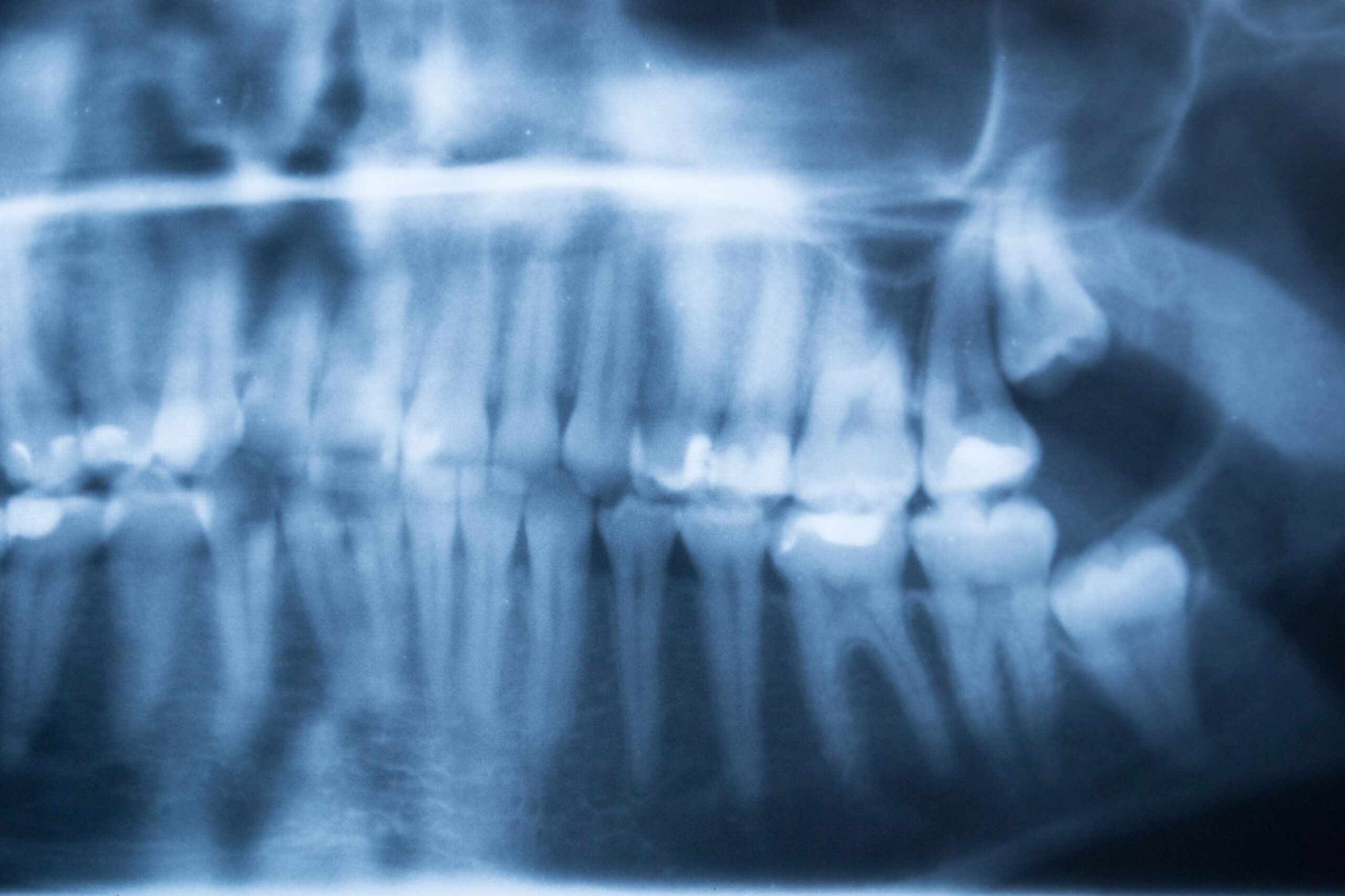 X-ray of wisdom teeth.