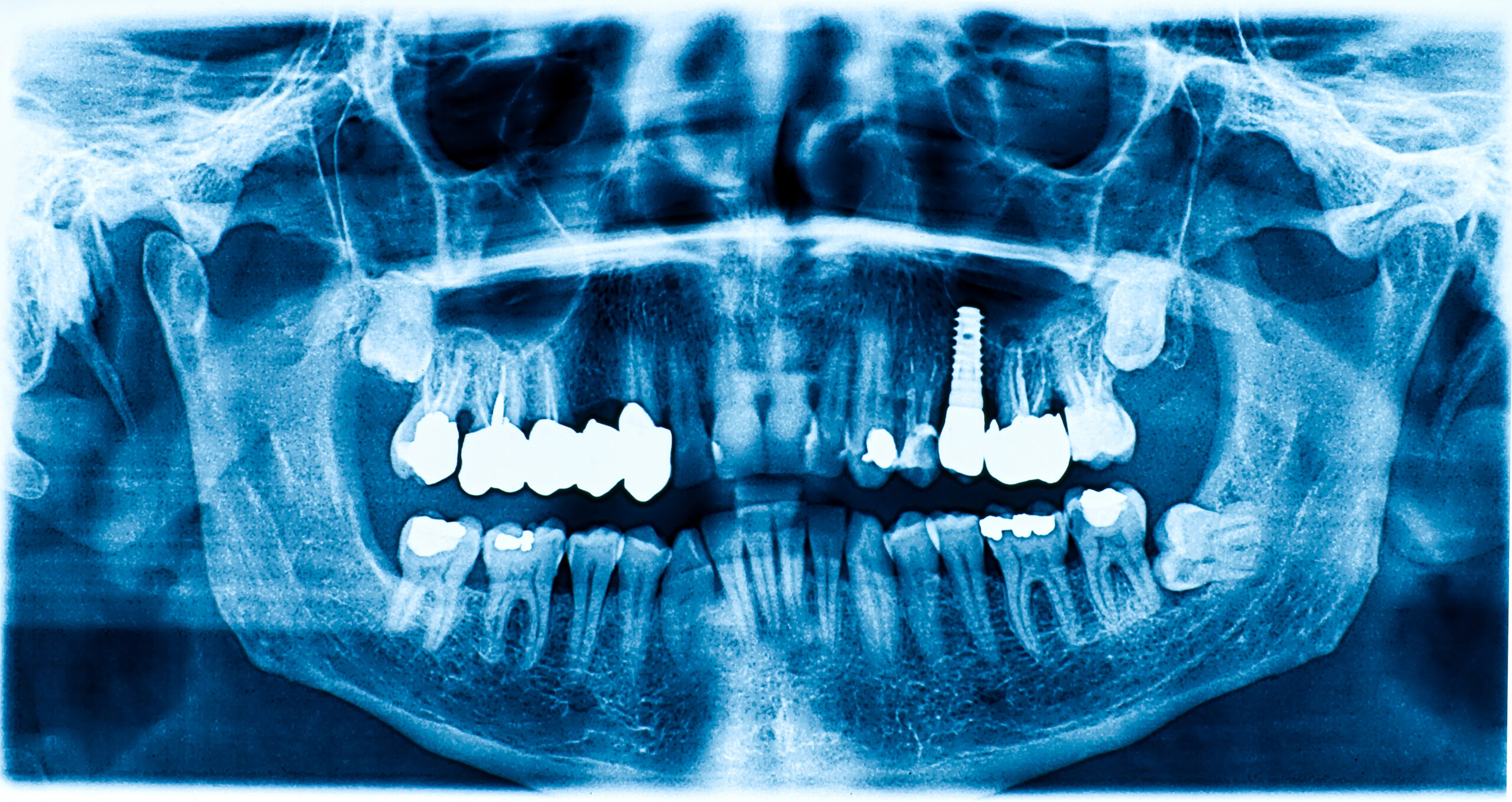 Dental X-ray showing dental implant and sinus cavities. 